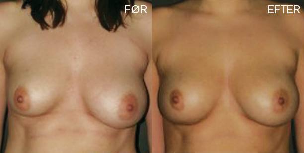 fedttransplantation-bryster-foer-og-efter
